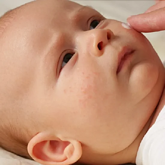 اصول مراقبت از پوست حساس نوزاد؛ پیشگیری از خشکی و اگزما